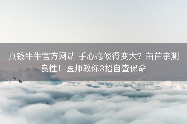 真钱牛牛官方网站 手心痣倏得变大？苗苗亲测良性！医师教你3招自查保命